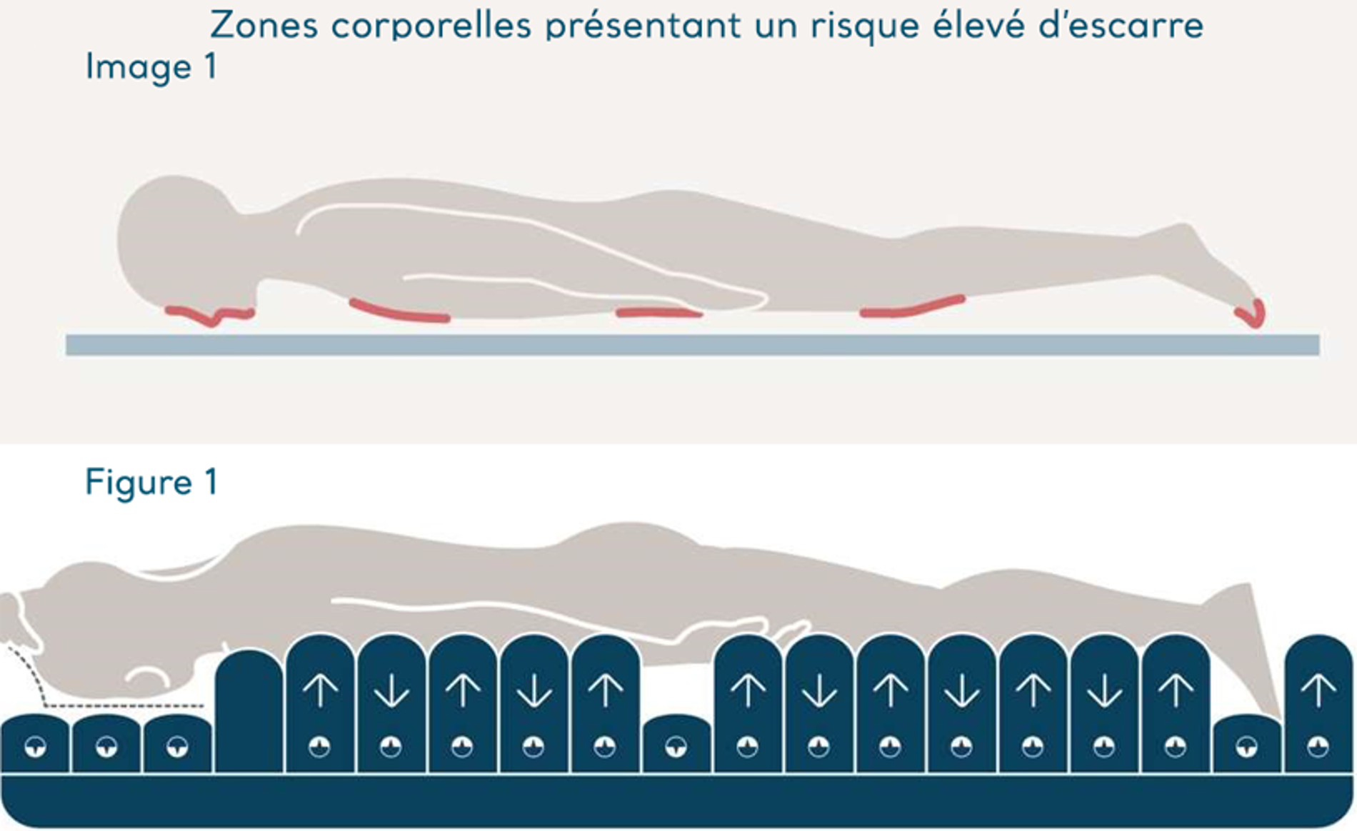 Schéma des zones corporelles présentant un risque élevé d'escarres